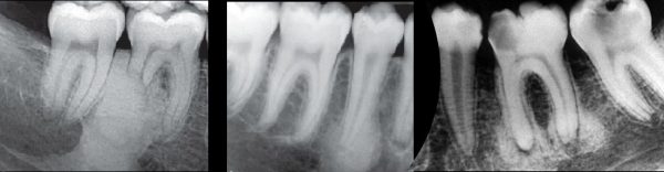Periapical Radiolucencies with Radiopacities (Online)