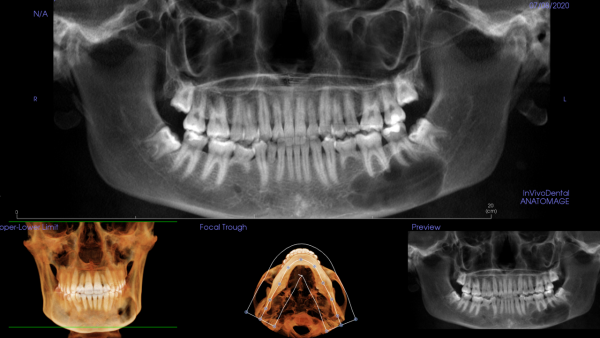 Well Defined Unilocular Radiolucencies (Online)