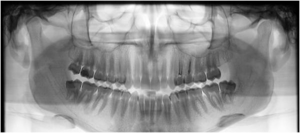 Strategic Panoramic Analysis: Understand the Panoramic Images, learn to recognize artifacts and real pathologies (Online)
